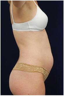 Tummy Tuck Before Photo by Michael Law, MD; Raleigh, NC - Case 28443