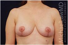 Breast Lift After Photo by Michael Law, MD; Raleigh, NC - Case 28444