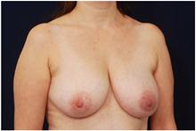 Breast Lift Before Photo by Michael Law, MD; Raleigh, NC - Case 28444