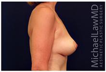 Breast Lift After Photo by Michael Law, MD; Raleigh, NC - Case 28445