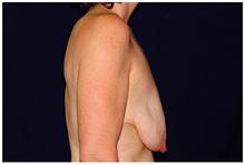 Breast Lift Before Photo by Michael Law, MD; Raleigh, NC - Case 28445