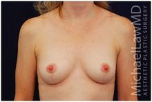 Breast Lift After Photo by Michael Law, MD; Raleigh, NC - Case 28446