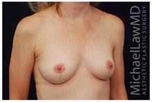 Breast Lift After Photo by Michael Law, MD; Raleigh, NC - Case 28446