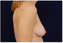 Breast Lift Before Photo by Michael Law, MD; Raleigh, NC - Case 28446