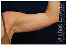 Arm Lift After Photo by Michael Law, MD; Raleigh, NC - Case 28449