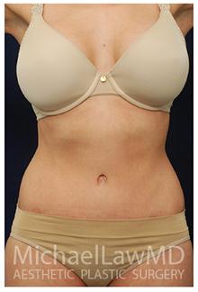Tummy Tuck After Photo by Michael Law, MD; Raleigh, NC - Case 28453