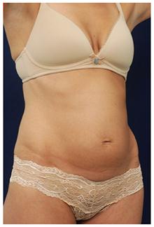 Tummy Tuck Before Photo by Michael Law, MD; Raleigh, NC - Case 28453