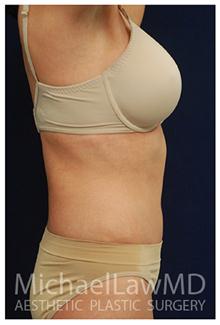 Tummy Tuck After Photo by Michael Law, MD; Raleigh, NC - Case 28453