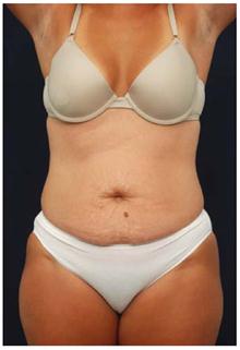 Tummy Tuck Before Photo by Michael Law, MD; Raleigh, NC - Case 28454