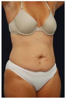 Tummy Tuck Before Photo by Michael Law, MD; Raleigh, NC - Case 28454