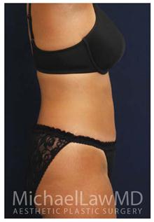 Tummy Tuck After Photo by Michael Law, MD; Raleigh, NC - Case 28454