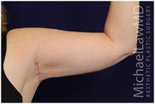 Arm Lift After Photo by Michael Law, MD; Raleigh, NC - Case 28456