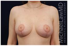 Breast Lift After Photo by Michael Law, MD; Raleigh, NC - Case 28457