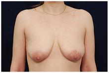 Breast Lift Before Photo by Michael Law, MD; Raleigh, NC - Case 28457