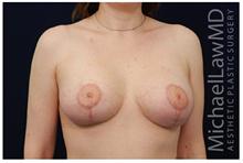 Breast Lift After Photo by Michael Law, MD; Raleigh, NC - Case 28457