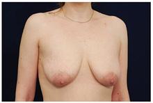 Breast Lift Before Photo by Michael Law, MD; Raleigh, NC - Case 28457