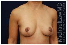 Breast Lift After Photo by Michael Law, MD; Raleigh, NC - Case 28458
