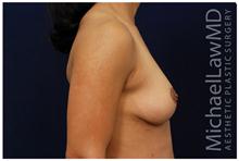 Breast Lift After Photo by Michael Law, MD; Raleigh, NC - Case 28458