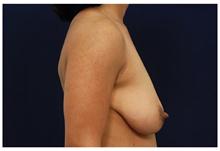 Breast Lift Before Photo by Michael Law, MD; Raleigh, NC - Case 28458