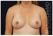 Breast Lift After Photo by Michael Law, MD; Raleigh, NC - Case 28459