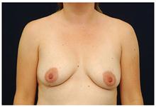 Breast Lift Before Photo by Michael Law, MD; Raleigh, NC - Case 28459