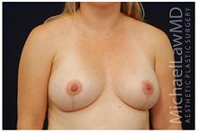 Breast Lift After Photo by Michael Law, MD; Raleigh, NC - Case 28459