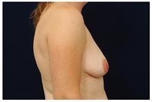 Breast Lift Before Photo by Michael Law, MD; Raleigh, NC - Case 28459
