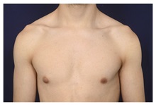 Male Breast Reduction Before Photo by Michael Law, MD; Raleigh, NC - Case 32959