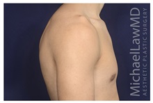 Male Breast Reduction After Photo by Michael Law, MD; Raleigh, NC - Case 32959