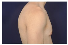 Male Breast Reduction Before Photo by Michael Law, MD; Raleigh, NC - Case 32959