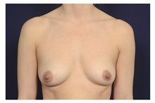 Breast Augmentation Before Photo by Michael Law, MD; Raleigh, NC - Case 32960