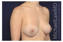 Breast Augmentation After Photo by Michael Law, MD; Raleigh, NC - Case 32960