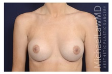 Breast Augmentation After Photo by Michael Law, MD; Raleigh, NC - Case 32961