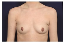 Breast Augmentation Before Photo by Michael Law, MD; Raleigh, NC - Case 32961