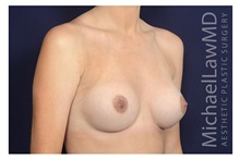 Breast Augmentation After Photo by Michael Law, MD; ,  - Case 32961