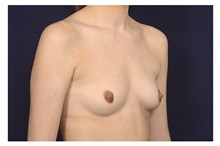 Breast Augmentation Before Photo by Michael Law, MD; ,  - Case 32961