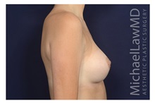 Breast Augmentation After Photo by Michael Law, MD; ,  - Case 32961