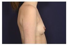 Breast Augmentation Before Photo by Michael Law, MD; ,  - Case 32961