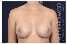 Breast Augmentation After Photo by Michael Law, MD; Raleigh, NC - Case 32962