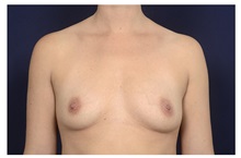 Breast Augmentation Before Photo by Michael Law, MD; Raleigh, NC - Case 32962