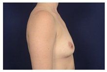 Breast Augmentation Before Photo by Michael Law, MD; Raleigh, NC - Case 32962