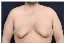 Male Breast Reduction Before Photo by Michael Law, MD; Raleigh, NC - Case 32963