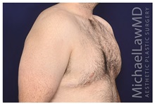 Male Breast Reduction After Photo by Michael Law, MD; Raleigh, NC - Case 32963