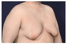 Male Breast Reduction Before Photo by Michael Law, MD; Raleigh, NC - Case 32963