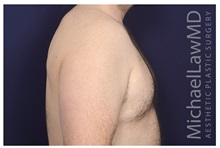 Male Breast Reduction After Photo by Michael Law, MD; Raleigh, NC - Case 32963