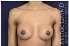 Breast Augmentation After Photo by Michael Law, MD; Raleigh, NC - Case 32964