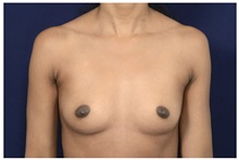 Breast Augmentation Before Photo by Michael Law, MD; Raleigh, NC - Case 32964