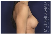 Breast Augmentation After Photo by Michael Law, MD; Raleigh, NC - Case 32964