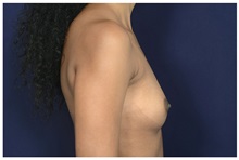 Breast Augmentation Before Photo by Michael Law, MD; Raleigh, NC - Case 32964