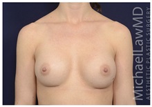 Breast Augmentation After Photo by Michael Law, MD; Raleigh, NC - Case 32965